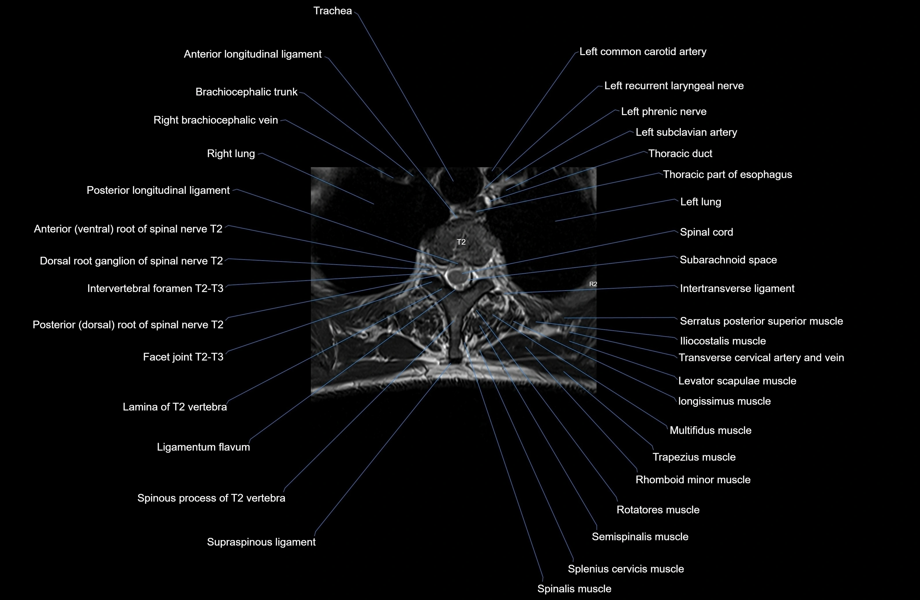 MRI thoracic spine axial  cross sectional anatomy 3T radiology  image-img-00001-00015.webp